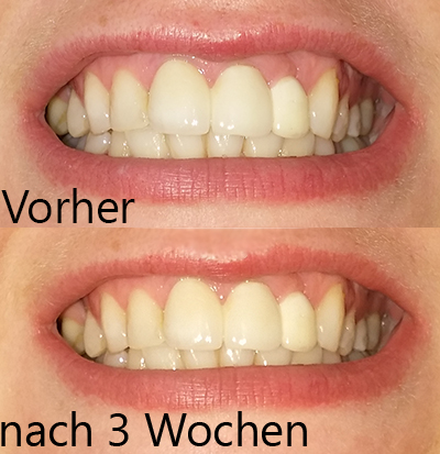 vergleich vorher nachher zähne