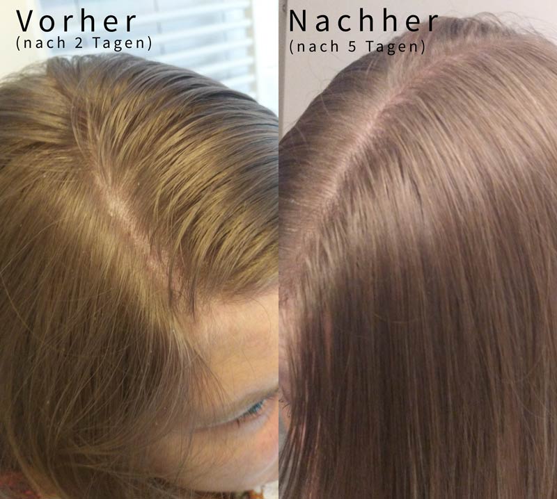 vorher-nachher-vergleich-roggenmehl-shampoo-fettige-haare